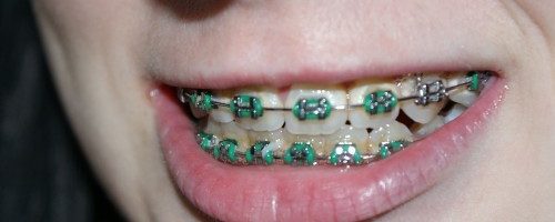 Aparat ortodontyczny – jak się z nim polubić?