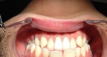 Co wpływa na zły stan naszych zębów?