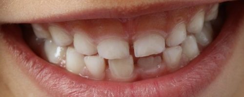 Pielęgnacja zębów – najczęściej popełniane błędy