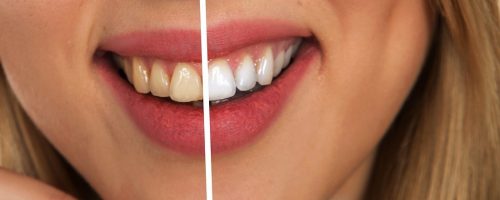 Sprawdzone metody na białe zęby!