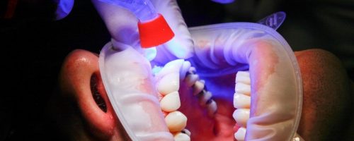 Wybielanie zębów a nasze zdrowie – co powinniśmy wiedzieć?