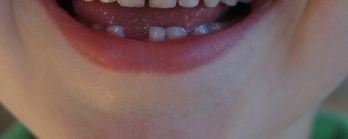 Złamane lub wybite zęby - pierwsza pomoc
