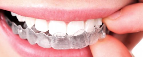 Jak leczenie ortodontyczne może odmienić Twoje życie?