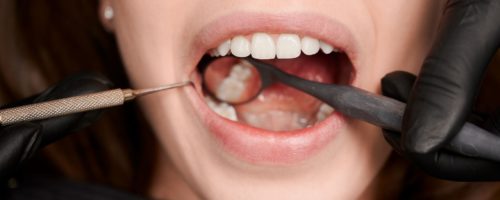 Uszkodzenie korony porcelanowej – co warto wiedzieć?