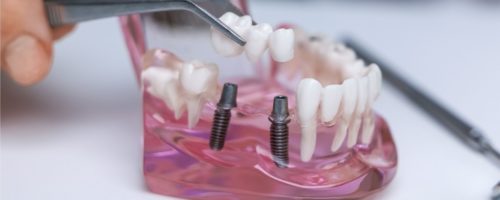 Przeciwwskazania do implantów zębowych
