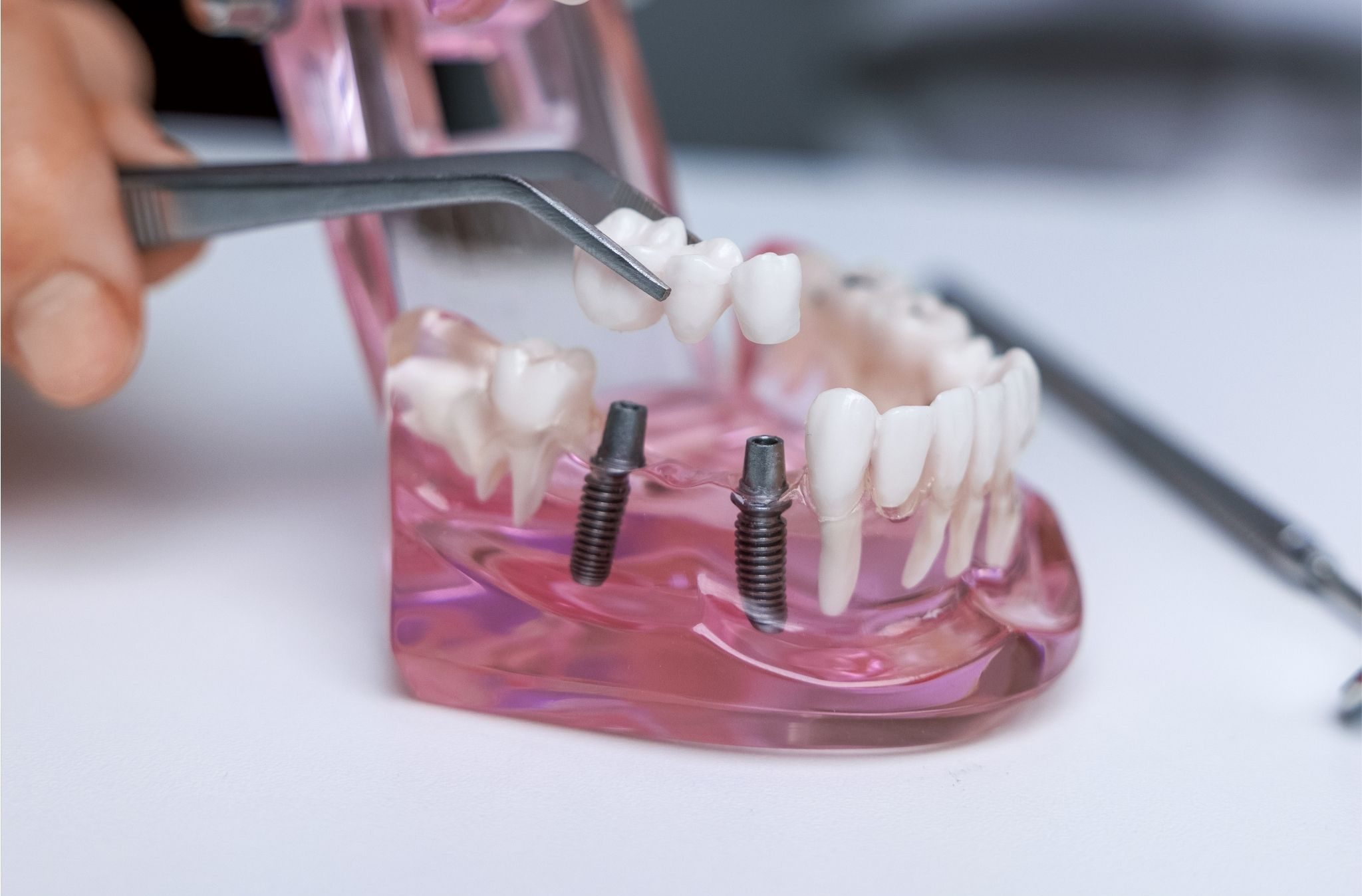 Czy implanty zębów trzeba wymieniać?