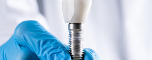 Rodzaje implantów zębowych