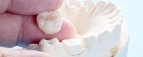 Ruszająca się korona zęba