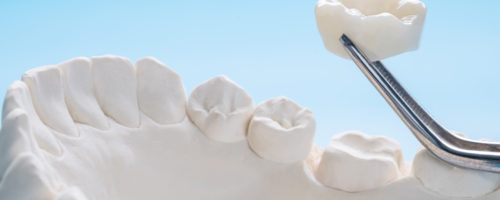 Kiedy można założyć koronę zęba? Najważniejsze wskazania i przeciwwskazania